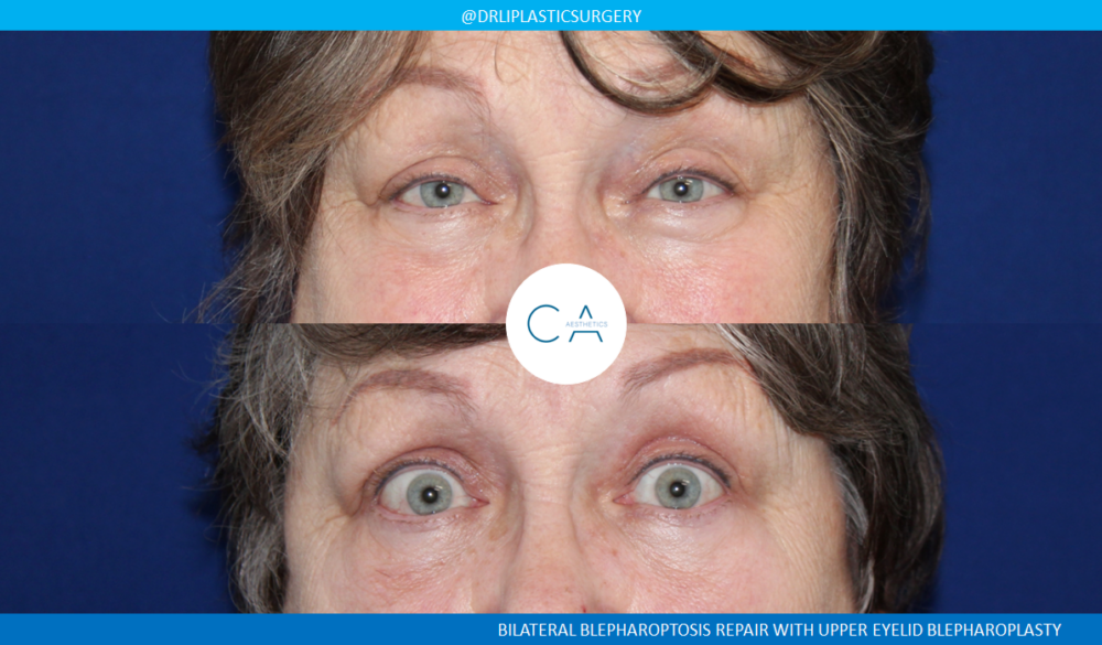 Upper Blepharoplasty case #3964