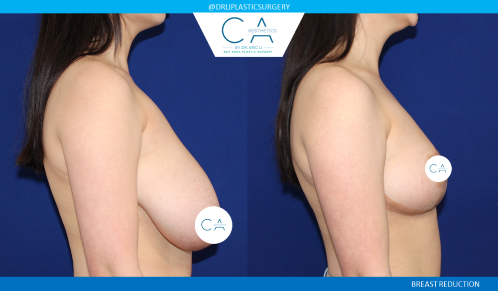 Breast Reduction case #3850