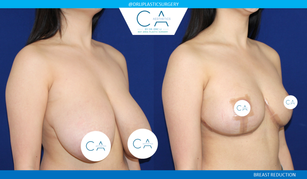 Breast Reduction case #3850