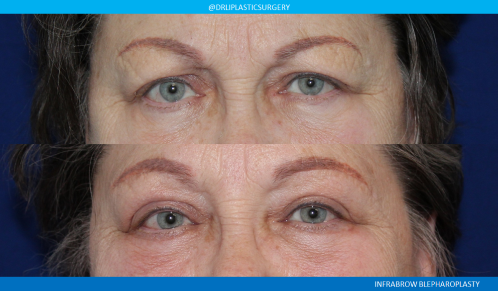 Upper Blepharoplasty case #3964