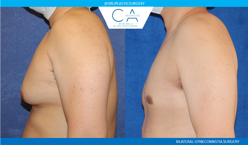 Gynecomastia case #2836