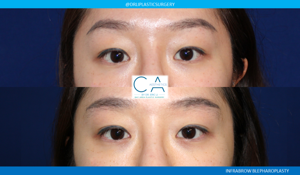 Asian Eyelid case #2371