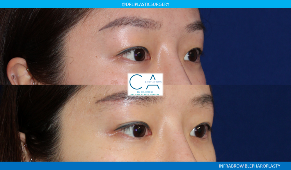 Asian Eyelid case #2371