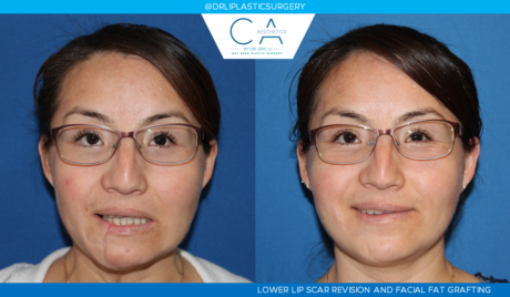 Facial Implants and Fat Transfer case #2798