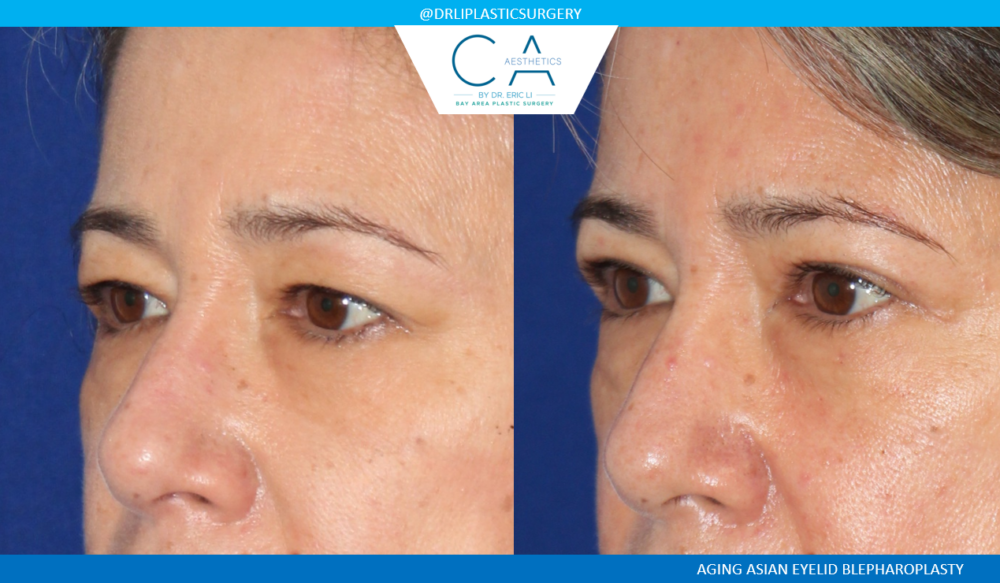 Upper Blepharoplasty case #3966