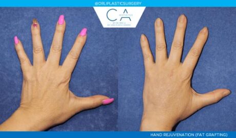 Hand Rejuvenation case #2884