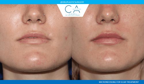 Microneedling case #3171