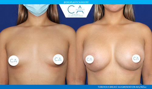Tuberous Breast Correction case #3464
