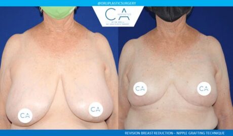 Breast Reduction case #3842