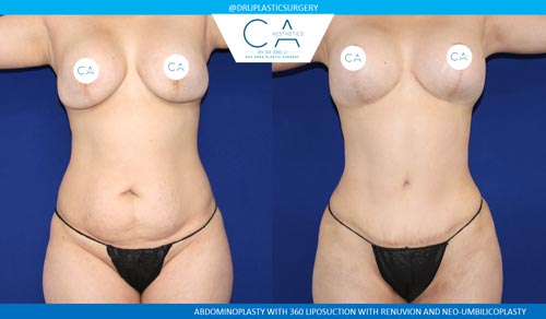 Tummy Tuck case #2528