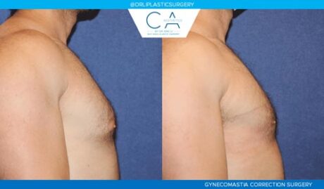 Gynecomastia case #2820