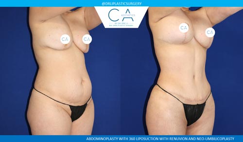 Tummy Tuck case #2528