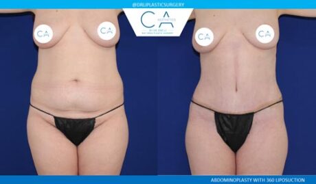 Tummy Tuck case #2567