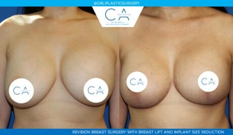 Breast Lift case #3519