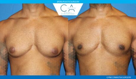 Gynecomastia case #2856