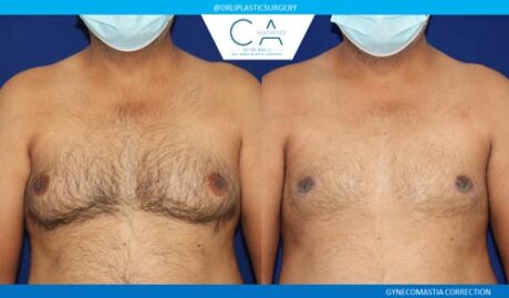 Gynecomastia case #2860