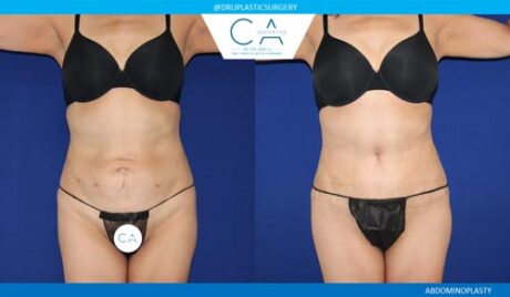 Tummy Tuck case #2573