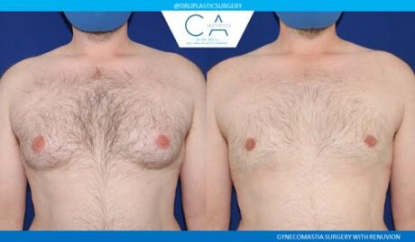 Gynecomastia case #2865