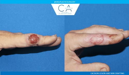 Mole Removal and Scar Revision case #3225