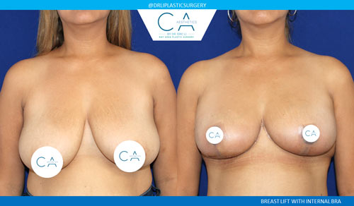 Breast Lift case #3525