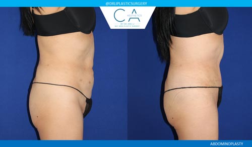 Tummy Tuck case #2573