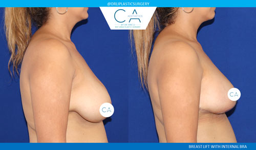 Breast Lift case #3525