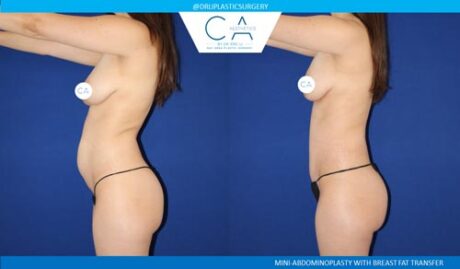 Tummy Tuck case #2575