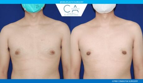 Gynecomastia case #2868