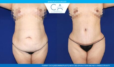 Tummy Tuck case #2581