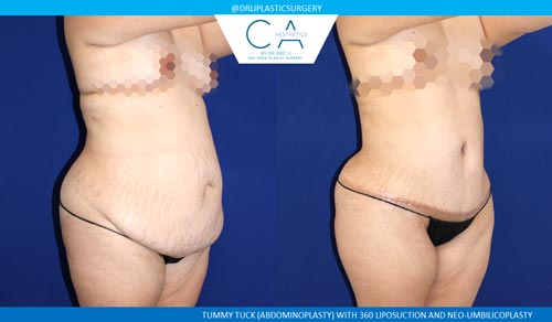 Tummy Tuck case #2581