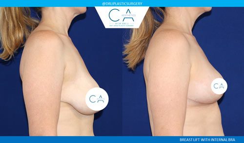 Breast Lift case #3533