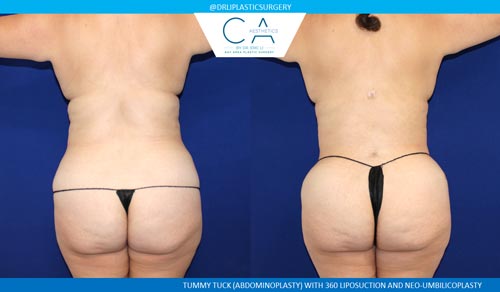 Tummy Tuck case #2581