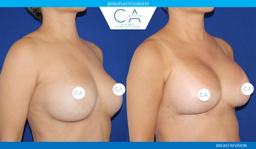 Breast Revision case #3760