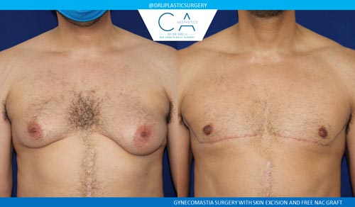 Gynecomastia case #2878