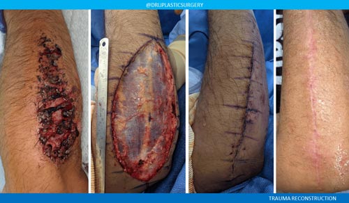 Mole Removal and Scar Revision case #3233
