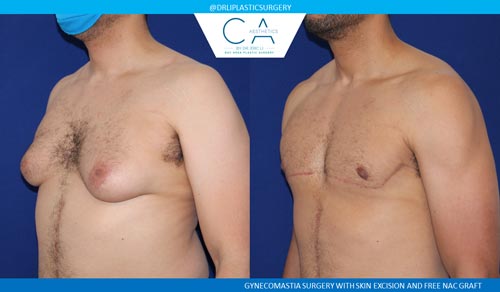 Gynecomastia case #2878