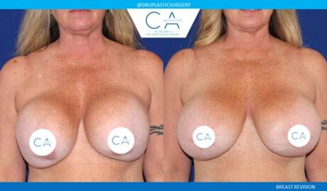 Breast Revision case #3770