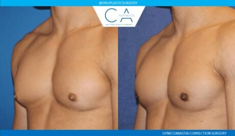 Gynecomastia case #2880