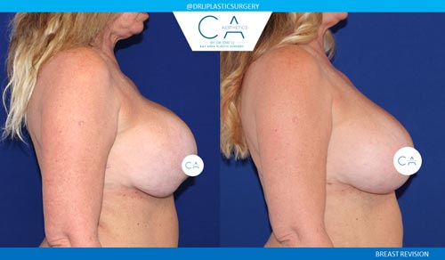 Breast Revision case #3770