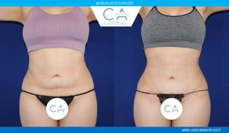 Tummy Tuck case #2592