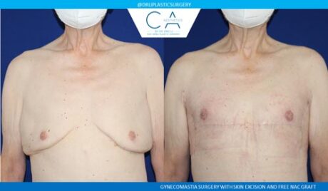 Gynecomastia case #2881