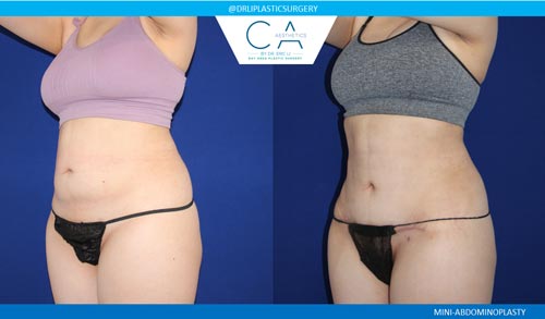 Tummy Tuck case #2592