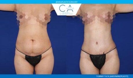 Tummy Tuck case #2596