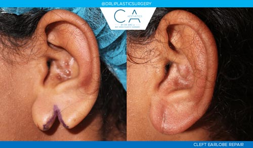 Mole Removal and Scar Revision case #3240