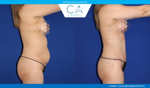 Tummy Tuck case #2596