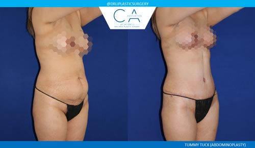 Tummy Tuck case #2596