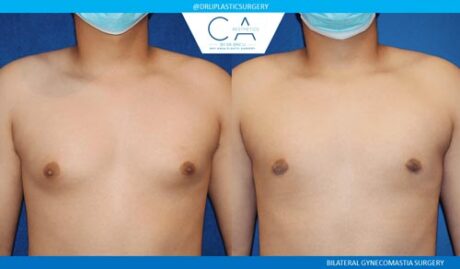 Gynecomastia case #2825