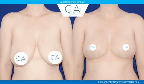 Breast Reduction case #3846