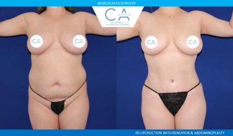 Tummy Tuck case #2533