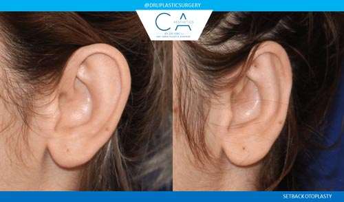 Otoplasty (Ear Surgery) case #3271